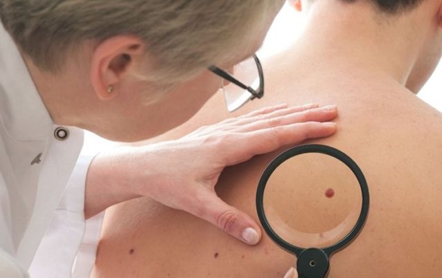 Hombres canadienses tienen más riesgo de morir por cáncer de piel que las mujeres