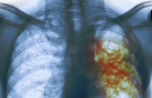 81 personas fueron posiblemente expuestas a tuberculosis en una escuela de Calgary