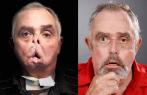 Médicos canadienses realizan el primer trasplante de rostro