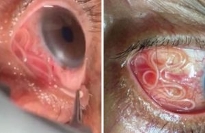 Fue al médico por molestias oculares y le extrajeron un gusano de 15 centímetros